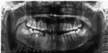 拔牙后不正確止血方法有哪些