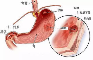 胃潰瘍手術(shù)有哪些方法