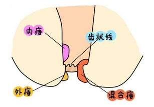 痔瘡術(shù)后十大注意事項(xiàng),痔瘡手術(shù)后的注意事項(xiàng),痔瘡術(shù)后注意事項(xiàng)及飲食禁忌
