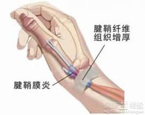 大拇指腱鞘炎要注意什么,大拇指腱鞘炎術(shù)后注意事項,大拇指腱鞘炎小針刀術(shù)后注意事項