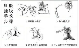 肛瘺,術(shù)前,注意事項