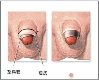 包皮環(huán)切器切除后注意事項(xiàng)