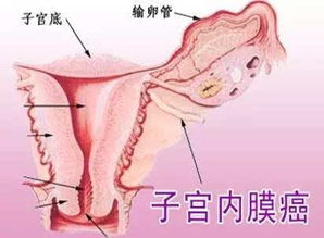 子宮內膜癌化療注意事項