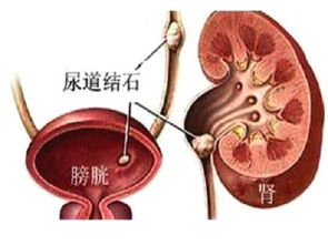 尿道結石飲食注意事項