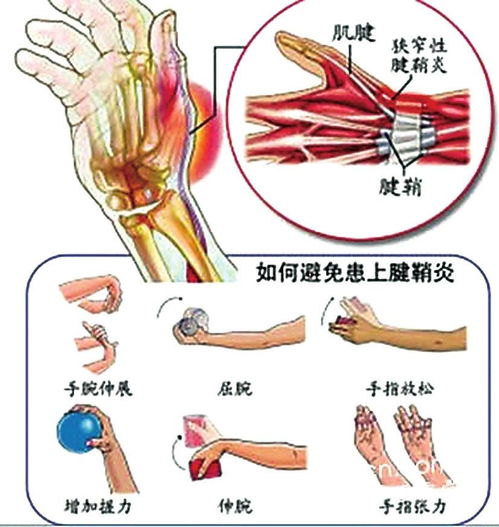 大拇指腱鞘炎注意事項
