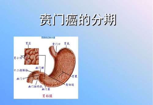 賁門癌手術(shù)體位注意事項,賁門癌的飲食注意事項,賁門癌術(shù)前注意事項