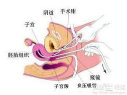 引產(chǎn),注意事項,有哪些