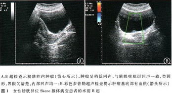 女性查體b超注意事項(xiàng)