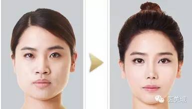 蛋白線(xiàn)面部提升注意事項