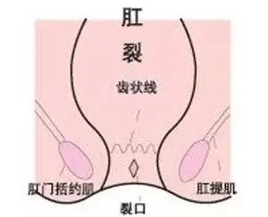 好了,注意事項,飲食,肛裂
