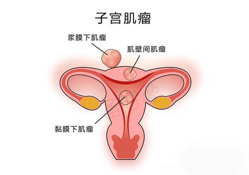 粘膜下子宮肌瘤宮腔鏡手術(shù)后注意事項