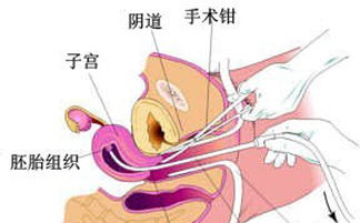無痛,做完,流產(chǎn),注意事項(xiàng)