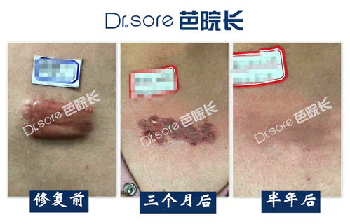 疤痕切除術后注意事項