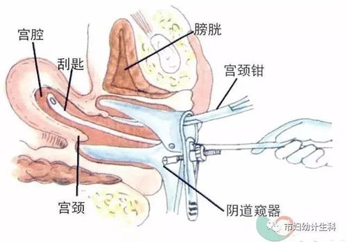 做無(wú)痛人流前需要注意什么,做無(wú)痛人流手術(shù)前需要注意什么,無(wú)痛人流手術(shù)前注意事項有哪些