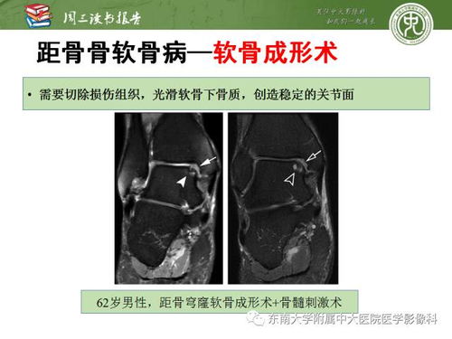 做ct后飲食注意事項