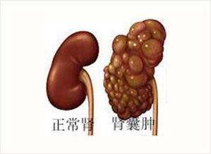 腎上有囊腫注意什么,腎囊腫注意事項及飲食,腎囊腫術(shù)后注意事項