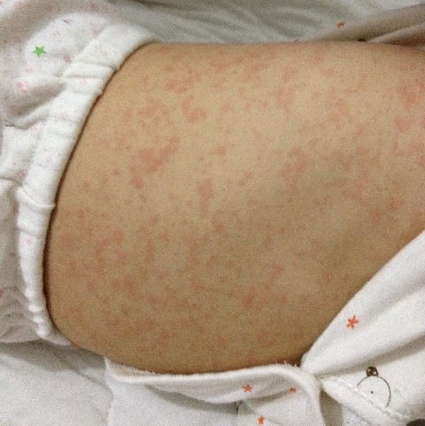小兒出疹子應該注意什么,小兒發(fā)燒出疹子的注意事項,小兒退燒出疹子注意事項
